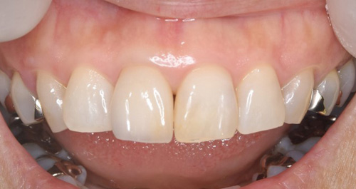 ジルコニアセラミック症例1 実施後