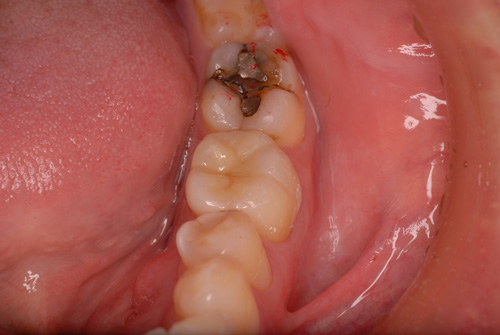 フルジルコニア症例1