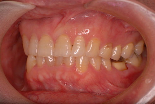 フルジルコニア症例2