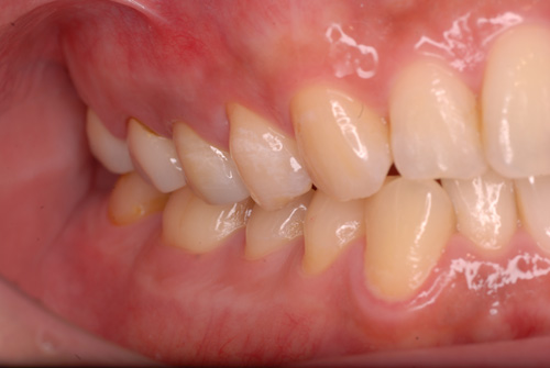 フルジルコニア症例3