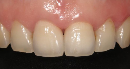 ジルコニアセラミック症例2 実施後