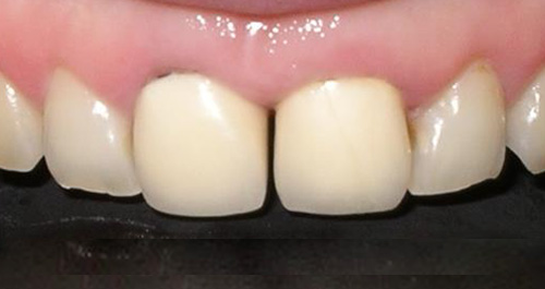 ジルコニアセラミック症例2 実施前
