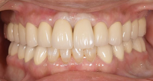 PFM症例1　実施後