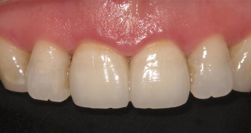 PFM症例2　実施後